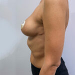 Редукционная маммопластика - после