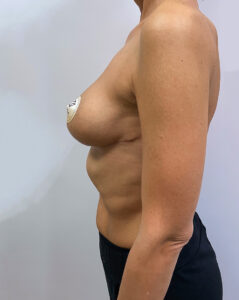 Редукционная маммопластика - после