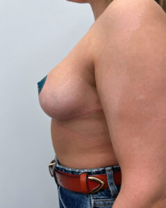 Редукционная маммопластика - после