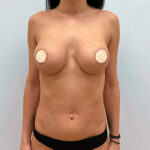 Реэндопротезирование - после