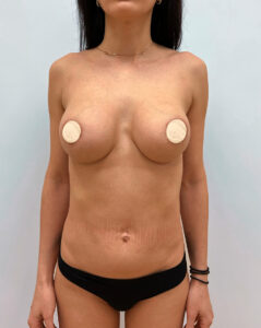 Реэндопротезирование - после