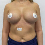 Реэндопротезирование - после