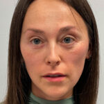 Нижняя блефаропластика - после