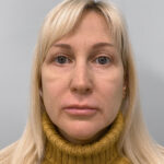 Круговая блефаропластика - после