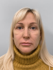 Круговая блефаропластика - после