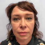 Круговая блефаропластика - после