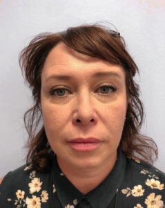 Круговая блефаропластика - после