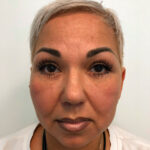 Круговая блефаропластика - после