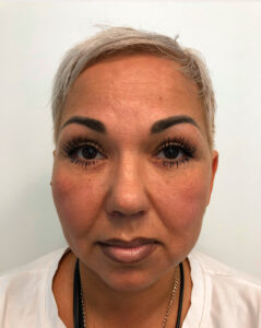 Круговая блефаропластика - после