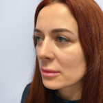 Верхняя блефаропластика - после