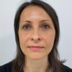 Верхняя блефаропластика - после