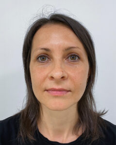 Верхняя блефаропластика - после