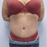 Абдоминопластика - после