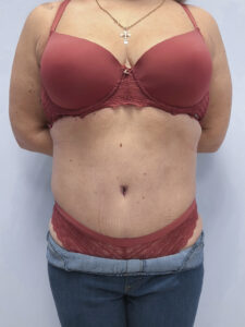 Абдоминопластика - после