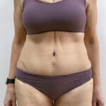 Абдоминопластика - после