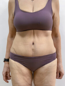 Абдоминопластика - после