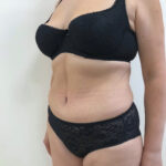 Абдоминопластика - после