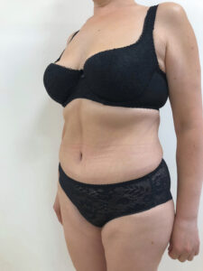 Абдоминопластика - после