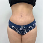 Абдоминопластика - после