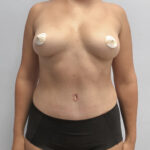 Абдоминопластика - после