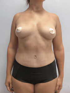 Абдоминопластика - после