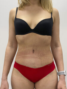 Абдоминопластика - после