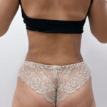 Липосакция - после