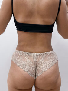 Липосакция - после