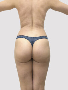 Липосакция - после