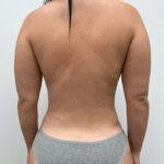 Липосакция - после