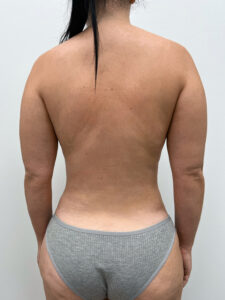 Липосакция - после