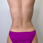 Липосакция - после
