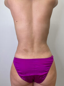 Липосакция - после