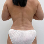 Липосакция - после