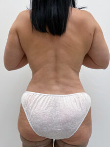 Липосакция - после