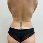 Липосакция - после