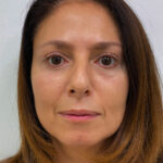 Эндоскопический лифтинг с блефаропластикой - после