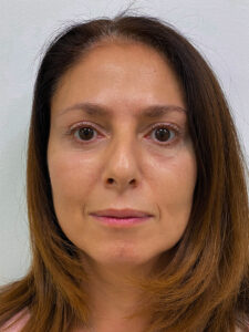 Эндоскопический лифтинг с блефаропластикой - после