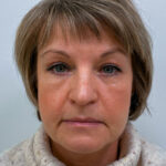 Эндоскопический лифтинг с блефаропластикой - после