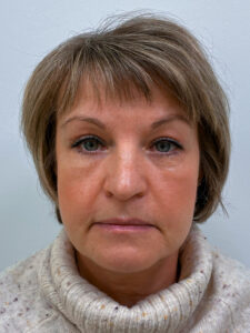 Эндоскопический лифтинг с блефаропластикой - после