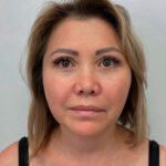 Эндоскопический лифтинг с блефаропластикой - после