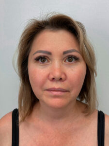 Эндоскопический лифтинг с блефаропластикой - после