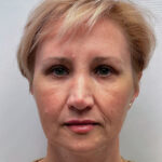 Эндоскопический лифтинг с блефаропластикой - после