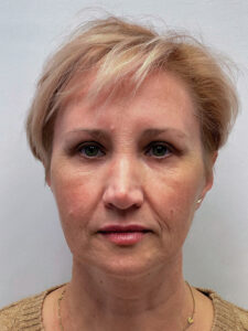 Эндоскопический лифтинг с блефаропластикой - после