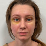 Эндоскопический лифтинг с блефаропластикой - после