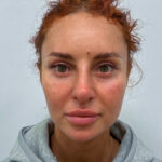 Эндоскопический лифтинг с блефаропластикой - после