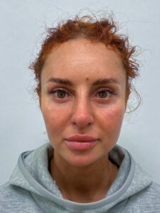 Эндоскопический лифтинг с блефаропластикой - после