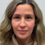 Эндоскопический лифтинг с блефаропластикой - после