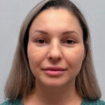 Эндоскопический лифтинг с блефаропластикой - после