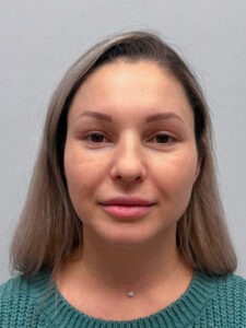 Эндоскопический лифтинг с блефаропластикой - после